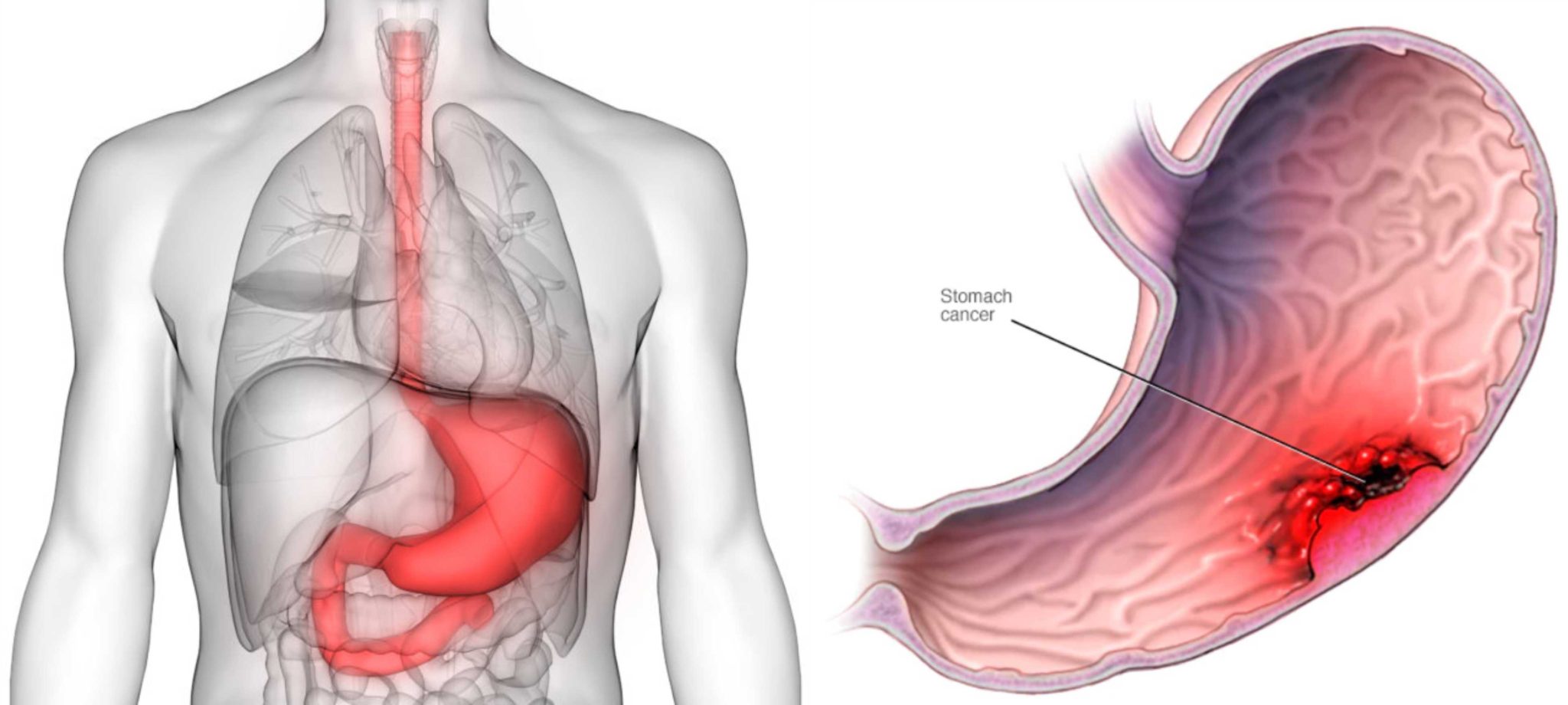 Does Stomach Cancer Always Show Up In Blood Tests